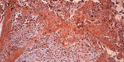 Malignant mesothelioma